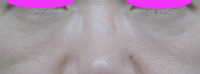 WPRPF lowerlid 1M 50y-thumb-200x74-1086.jpgのサムネール画像